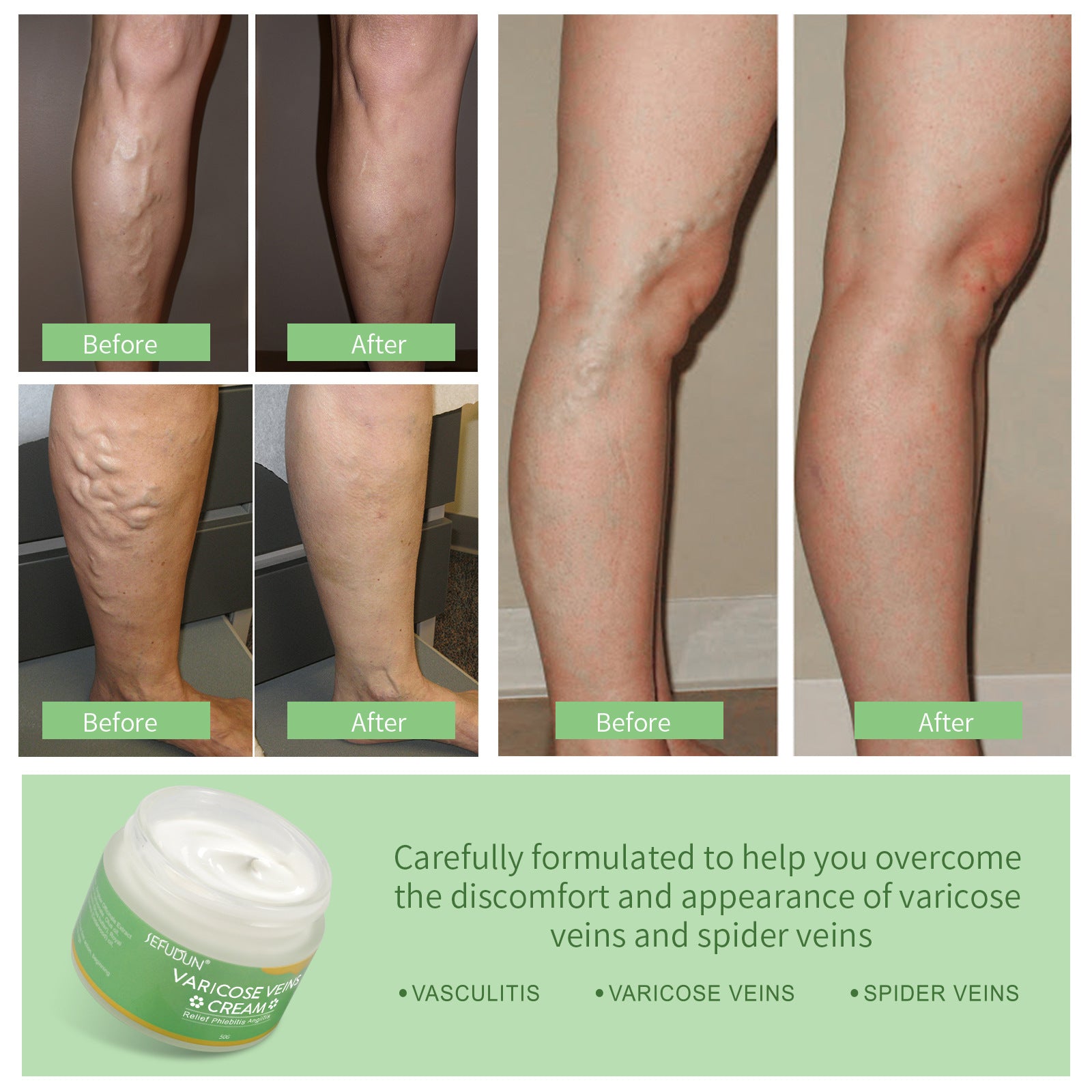 Varicose Vein Relief Cream - Safflower and Natural Herbs Skin Care Lotion for Leg Pain and Swelling